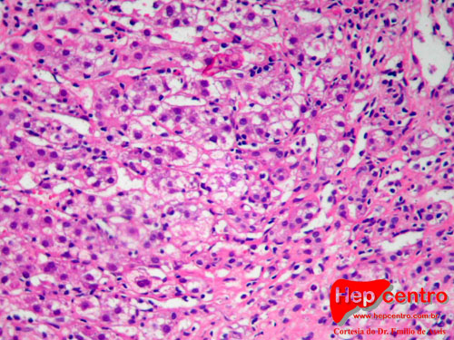 atividade lobular e balonização copy