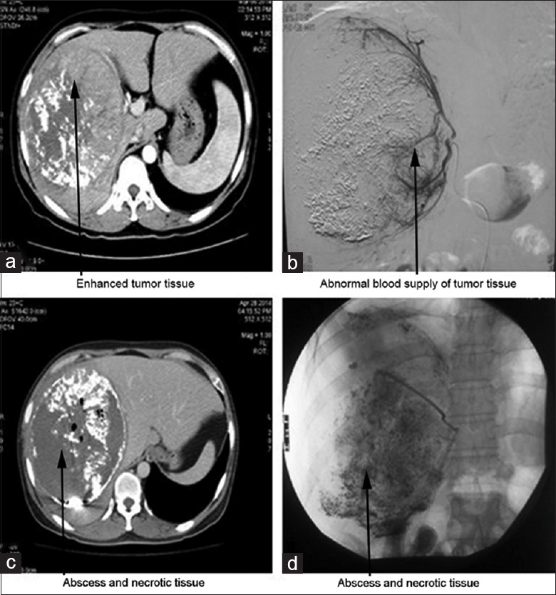 Imagens de um homem de 41 anos com hepatocarcinoma primário evoluindo com abscesso após quimioembolização transarterial. (a) imagem após primeira QE; (b) imagem após segunda sessão; (c) imagem após a segunda sessão mostrando abscesso; (d) imagem após drenagem percutânea do abscesso