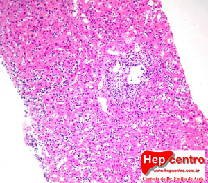 hepatite aguda por EBV copy