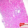 hepatite aguda por EBV copy