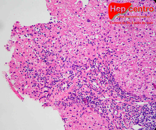 hepatitis de interface copy