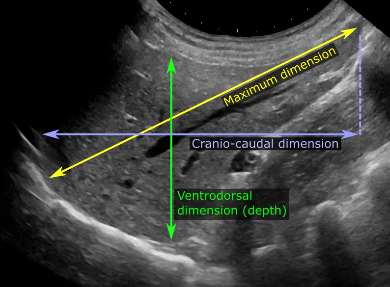 Liver_measurements_on_ultrasonography