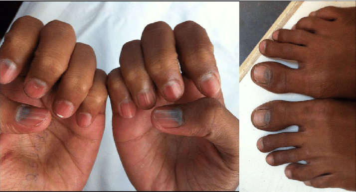 lunulae ceruleae (unhas em safira)