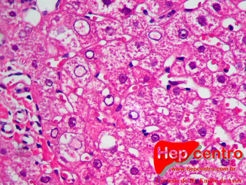 nucleos glicogenados e balonização (doença de wilson) copy