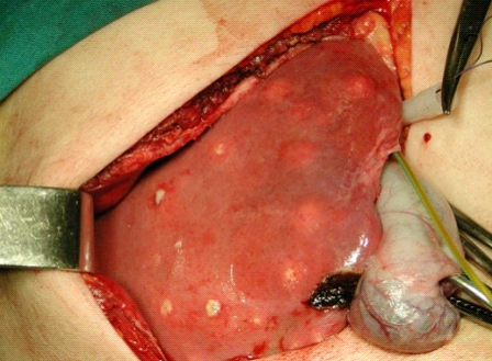 Pyogenic-Liver-Abscess
