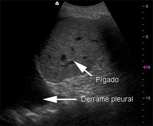 derramepleural