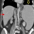 esplenomegalia2