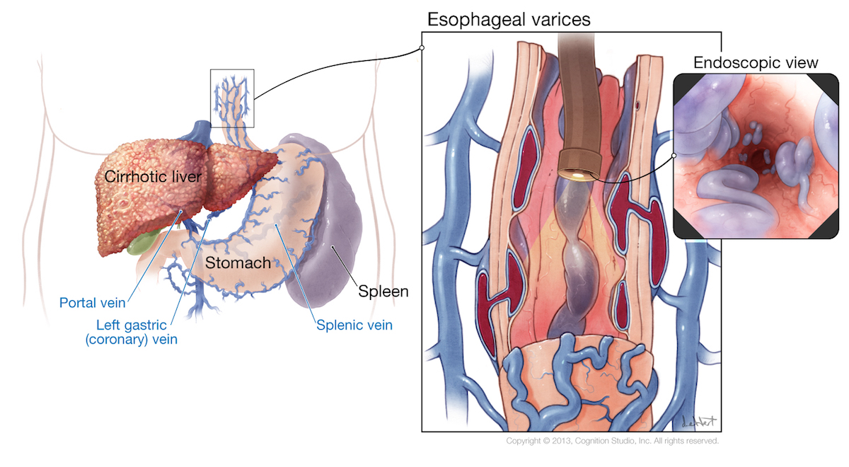 HCV-Phase1-series_r2