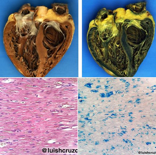 hemocromatosecoracao