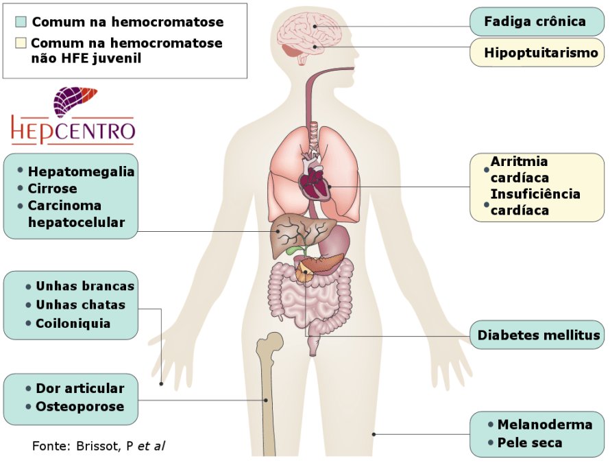 hemocromatosesintomas