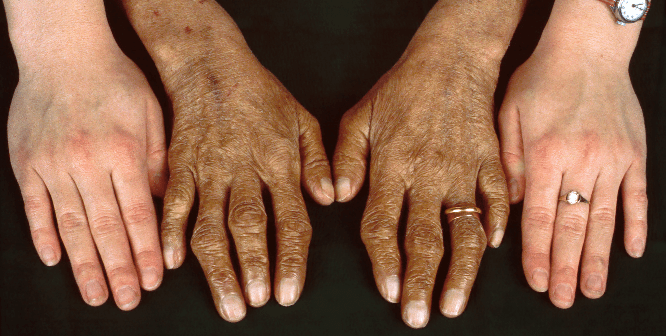 Screenshot_2020-06-04 Hereditary Hemochromatosis - Hematology and Oncology - MSD Manual Professional Edition