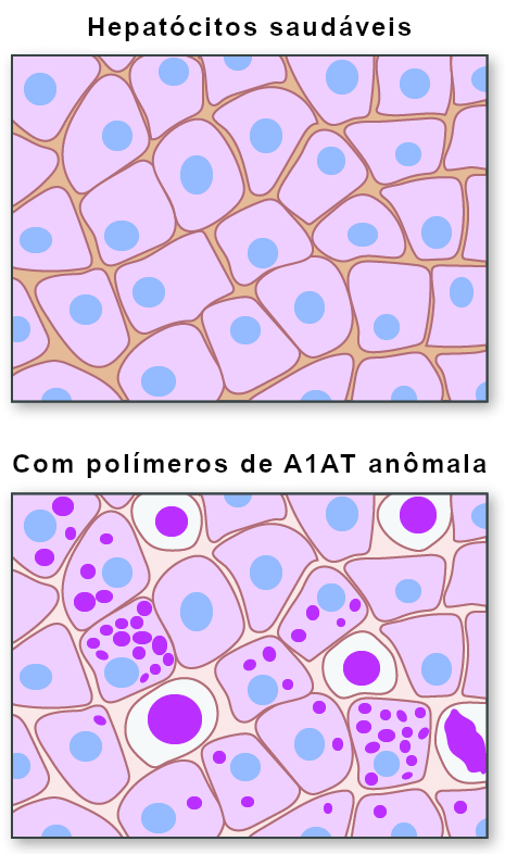 Hepatócitos na DA1AT. Adaptado de Learn.Genetics