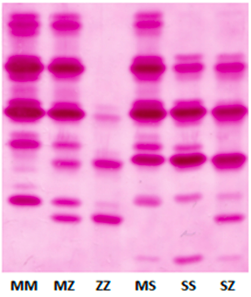 Eletroforese de focalização isoelétrica (IEF) mostrando padrões diferentes de acordo com a A1AT. MM é a enzima normal. Carroll, 2014.